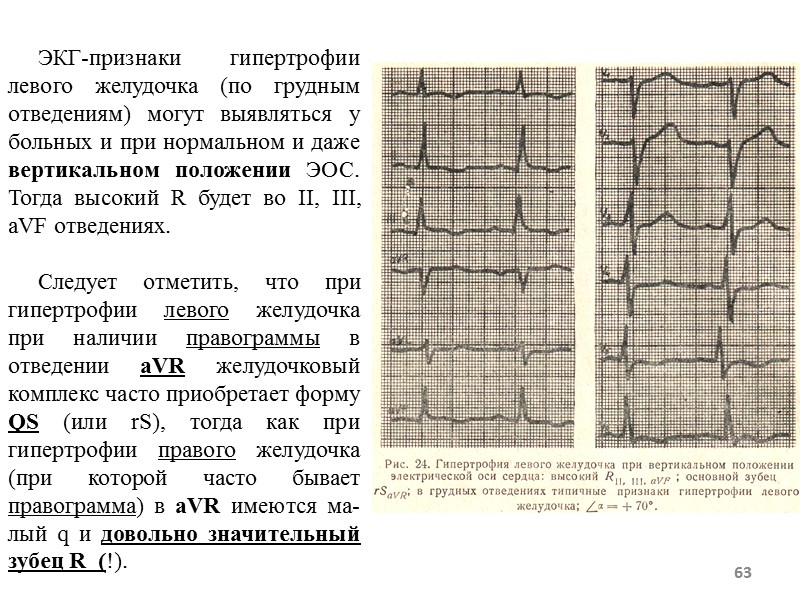 63 ЭКГ-признаки гипертрофии левого желудочка (по грудным отведениям) могут 63 ЭКГ-признаки гипертрофии левого желудочка (по грудным отведениям) могут